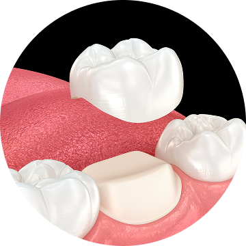 Dental Crowns