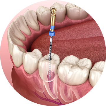 Root Canal Treatment